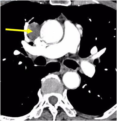 Resection of Thymic Neuroendocrine Carcinoma Guided by Three-Dimensional Reconstruction: A Case Report